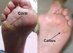 7 Home Remedies to Get Rid of a Writer's Callus Painlessly
